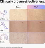 Braun Smart IPL Skin iexpert PL7253 IPL device Braun Smart IPL Skin iexpert PL7253 IPL device